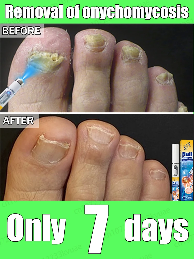 

Say goodbye to onychomycosis scientifically and safely,This is a product worth buying