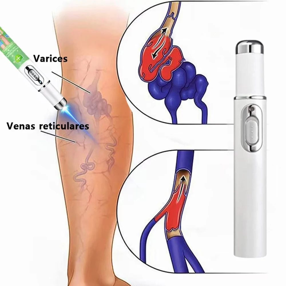 

Varicose vein laser pointer Improves Blood Circulation Reduces Spider Veins and Heaviness Blue Light Acne Removing Pen