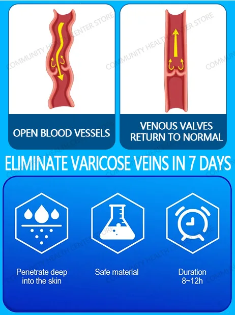 veines Pᴏᴅᴇʀᴏsᴀ ᴛᴇʀᴀᴘɪᴀ ᴀ laser ᴘᴀʀᴀ ᴠᴀʀɪᴢᴇs ᴍᴏᴅᴇʀᴀᴅᴀs, ᴀʟɪᴠɪᴀ ᴀ ᴅᴏʀ ᴇ ᴍᴇʟʜᴏʀᴀ ᴀ ᴄɪʀᴄᴜʟᴀᴄ̧ᴀ̃ᴏ ᴘᴀʀᴀ ʜᴏᴍᴇɴs ᴇ ᴍᴜʟʜᴇʀᴇs