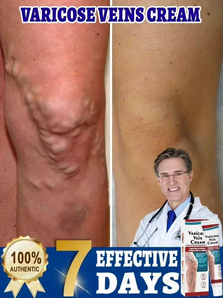 Effective Varicose Vein Relief  Ointment For Varicose Veins