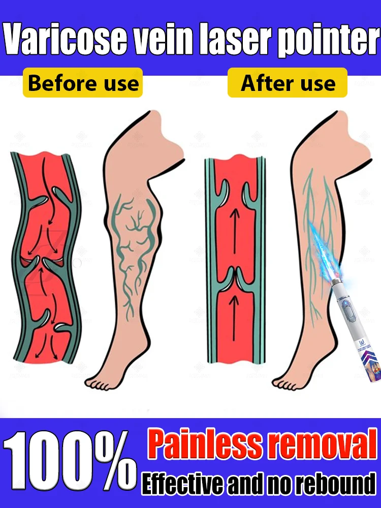 

Reverse leg health in 7 days and say goodbye to varicose vein recurrence