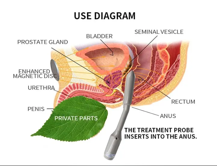 Factory Supply Male Prostate Stimulator for BPH Seminal Vesiculitis and ED