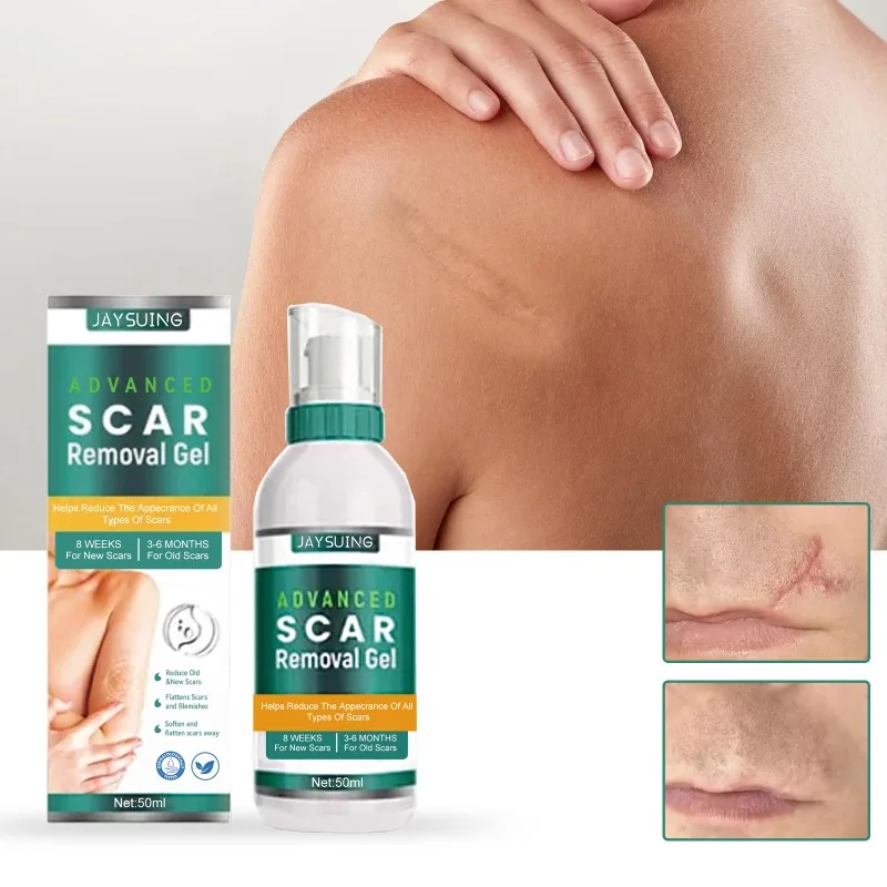 Skin Scar Removal Cream For Burns Surgery Hyperplasia Acne Marks Fade old Scars Stretch Marks Pigment Skin repair Care Gel