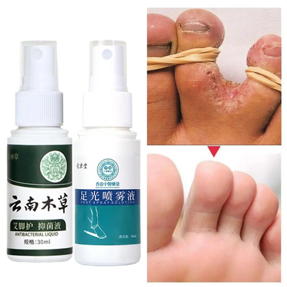 Effective  Athlete Foot Spray Safe Alleviate Blisters Foot Cream Toe Treatment Reduce Smelly Feet Foot Spray for Household