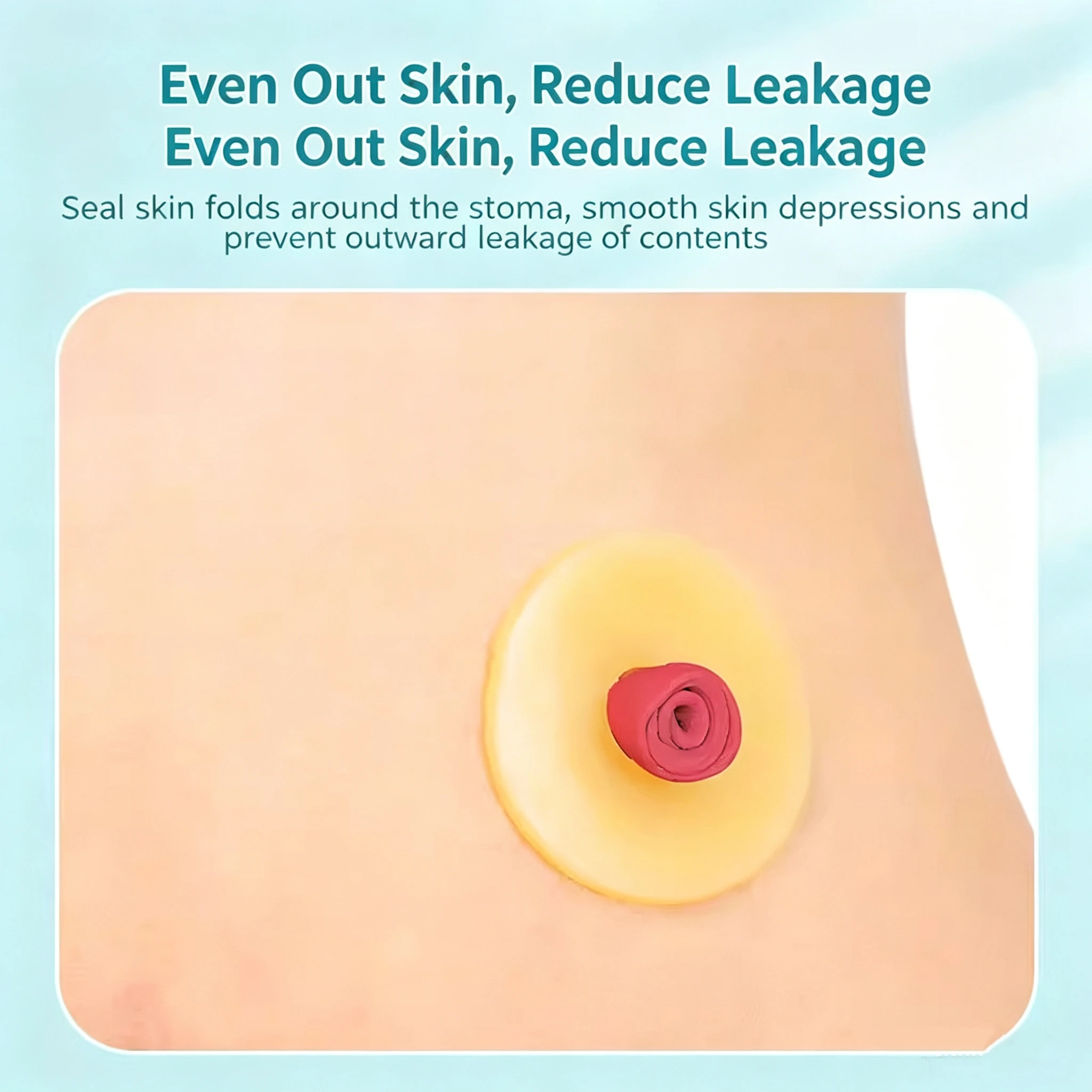 Ostomy Barrier Ring Hydrocolloid Seal Leak Proof Stoma Care Colostomy for Colostomy Ileostomy  Urostomy Care Skin Protection