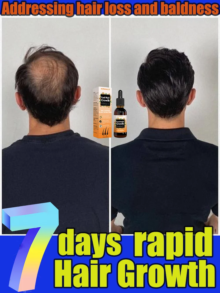 

Rᴀᴘɪᴅ ɢʀᴏᴡᴛʜ ʜᴀɪʀʟɪɴᴇ ᴄᴀʀᴇ sᴄᴀʟᴘ ᴛᴏ ᴘʀᴇᴠᴇɴᴛ ʜᴀɪʀ ғᴏʟʟɪᴄʟᴇ sʜᴇᴅᴅɪɴɢ ᴇssᴇɴᴄᴇ ɴᴜᴛʀɪᴇɴᴛ sᴏʟᴜᴛɪᴏɴ ғᴏʀ ᴍᴇɴ ᴀɴᴅ ᴡᴏᴍᴇɴ