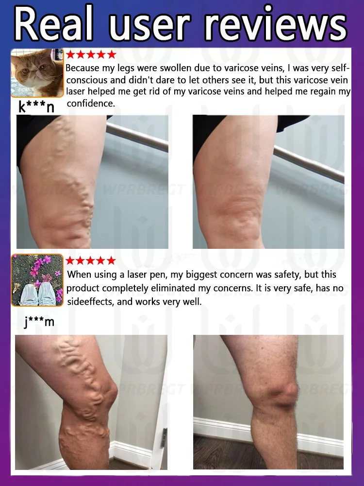 Eine neue Generation von Krampfadern zur Behandlung von Venenentzündungen, Spinnenadern und geschwollenen Adern