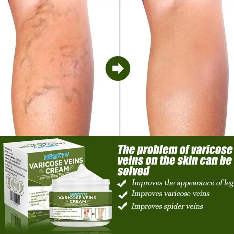 

50g Varicoses Veins Cream Remove Spide Veins Fade Sophora Japonica Extract Moisturize Skin For Oil Skin And Dry Skin