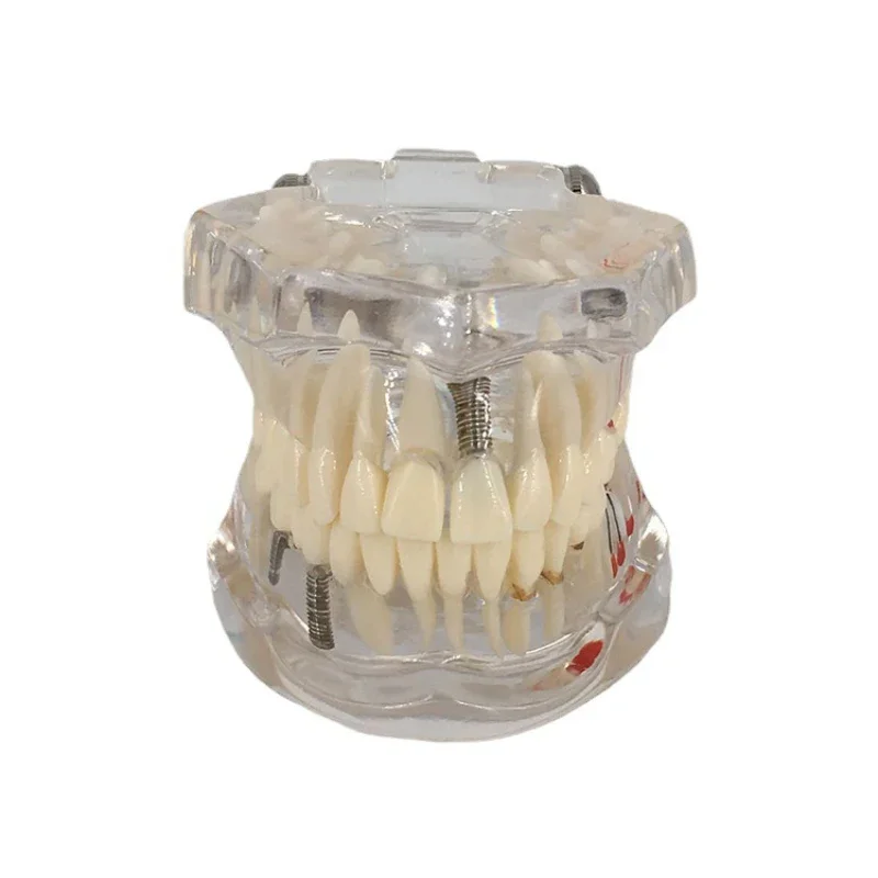

Transparent Disease Teeth Model Dental Implant Teeth Model Dentist Student Learning Education Research Communication