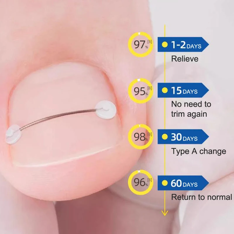 Kit de corrección de uñas encarnadas, tratamiento de uñas encarnadas, parches de corrección elásticos, pegatinas, Clip alisador, soporte