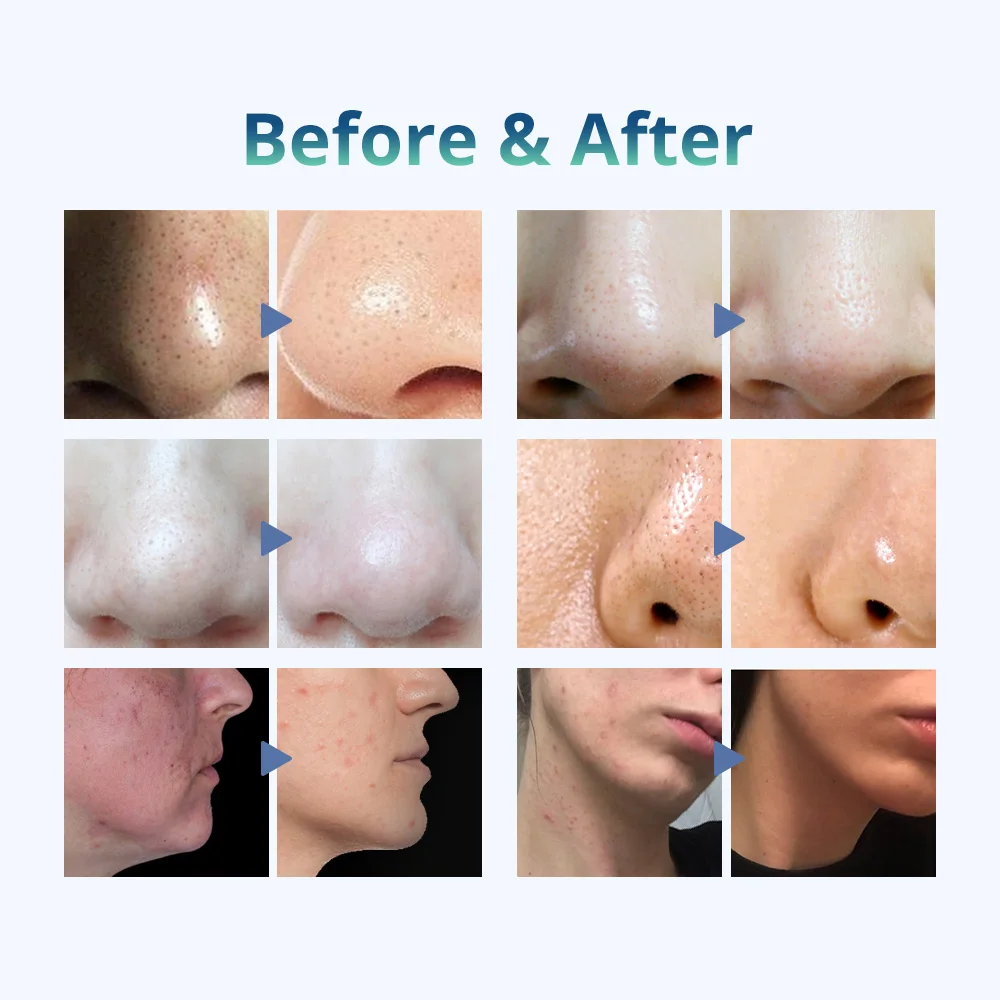 6-in-1 ultrasone huidscrubber Foton Microdermabrasie Sproeier Koelmachine