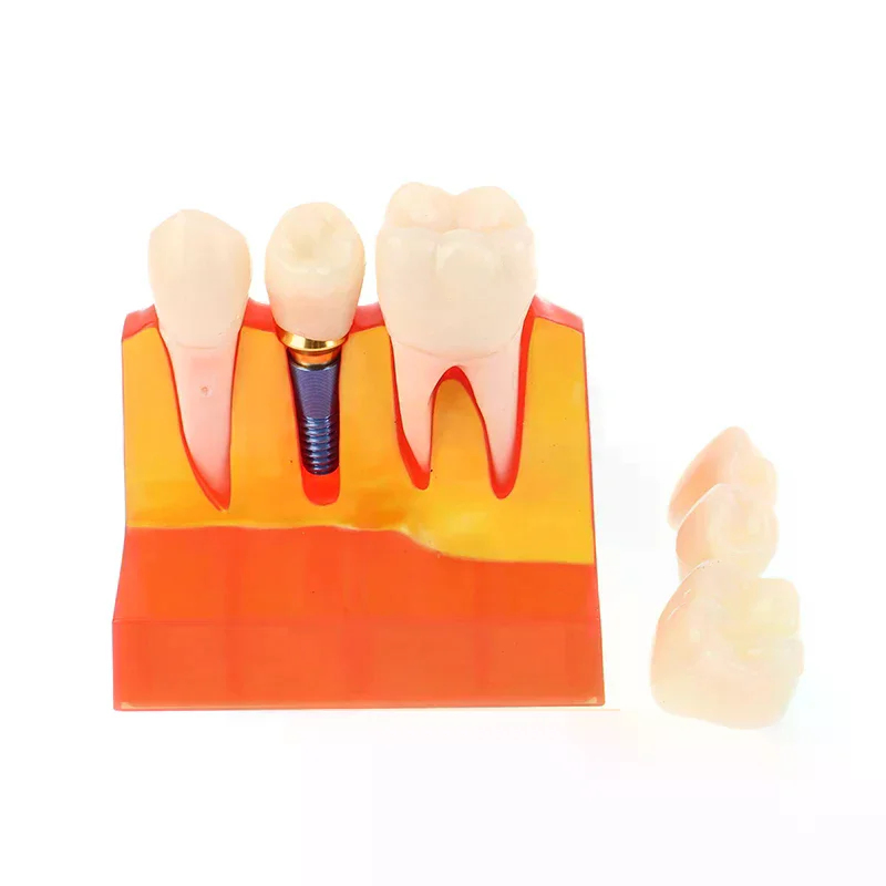 4 Times Implant Teeth Model Analysis Crown Bridge Demonstration Removable Model Dentistry Study Training Teaching Model Dental