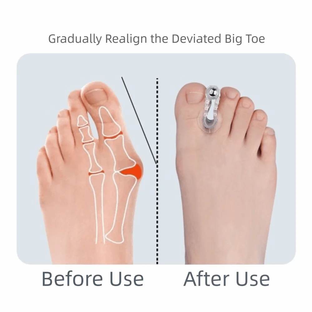 Gel Material Bunion Corrector Elastic Design Anti Slip Hallux Valgus Corrector Original Shape Comfortable Wear Toe Spreader