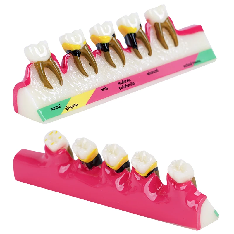 1pc Periodontal Disease Model 5-Stage Perio Disease Assort Demo Caries Periodontitis Dental Teeth Model