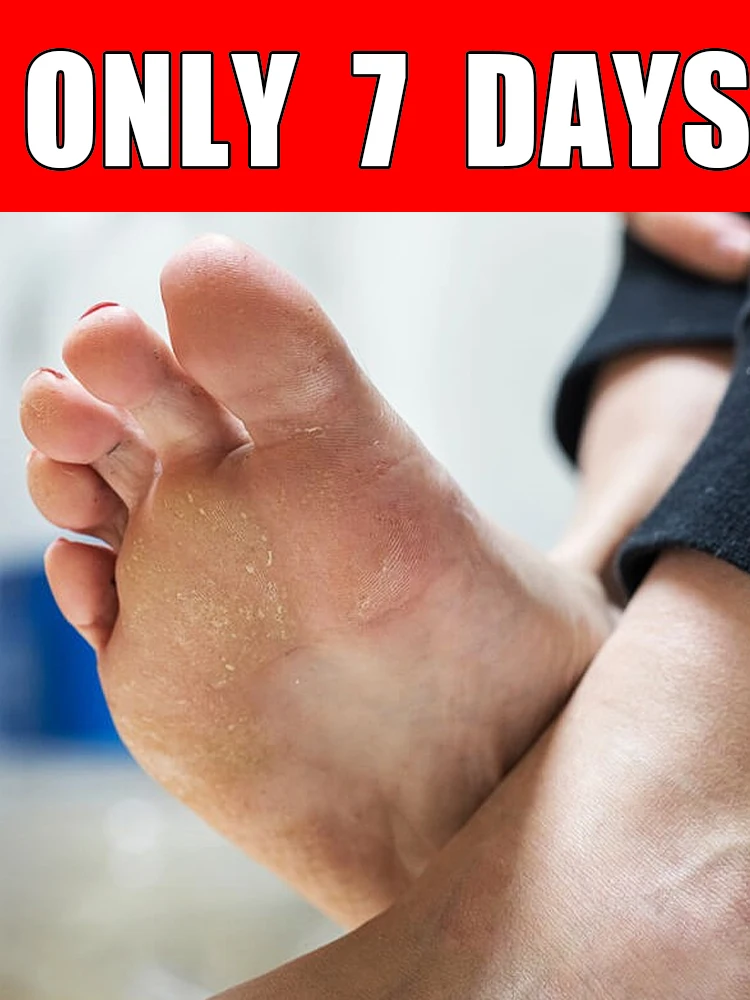 

7-Dᴀʏ Fᴏᴏᴛ Exғᴏʟɪᴀᴛɪɴɢ Sᴘʀᴀʏ, sᴜɪᴛᴀʙʟᴇ ғᴏʀ ᴅʀʏ, ʀᴏᴜɢʜ, ᴄʀᴀᴄᴋᴇᴅ ғᴇᴇᴛ, ʜᴇᴇʟs,