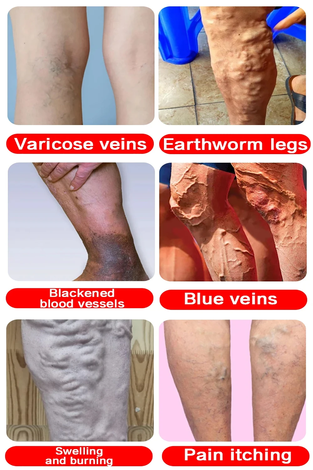 Terapia d'abat-jour pour varices, efficace, améliore la Circulation sanguine, soulagement de la vascularite dilatée, produit de soins pour la phlébite des jambes