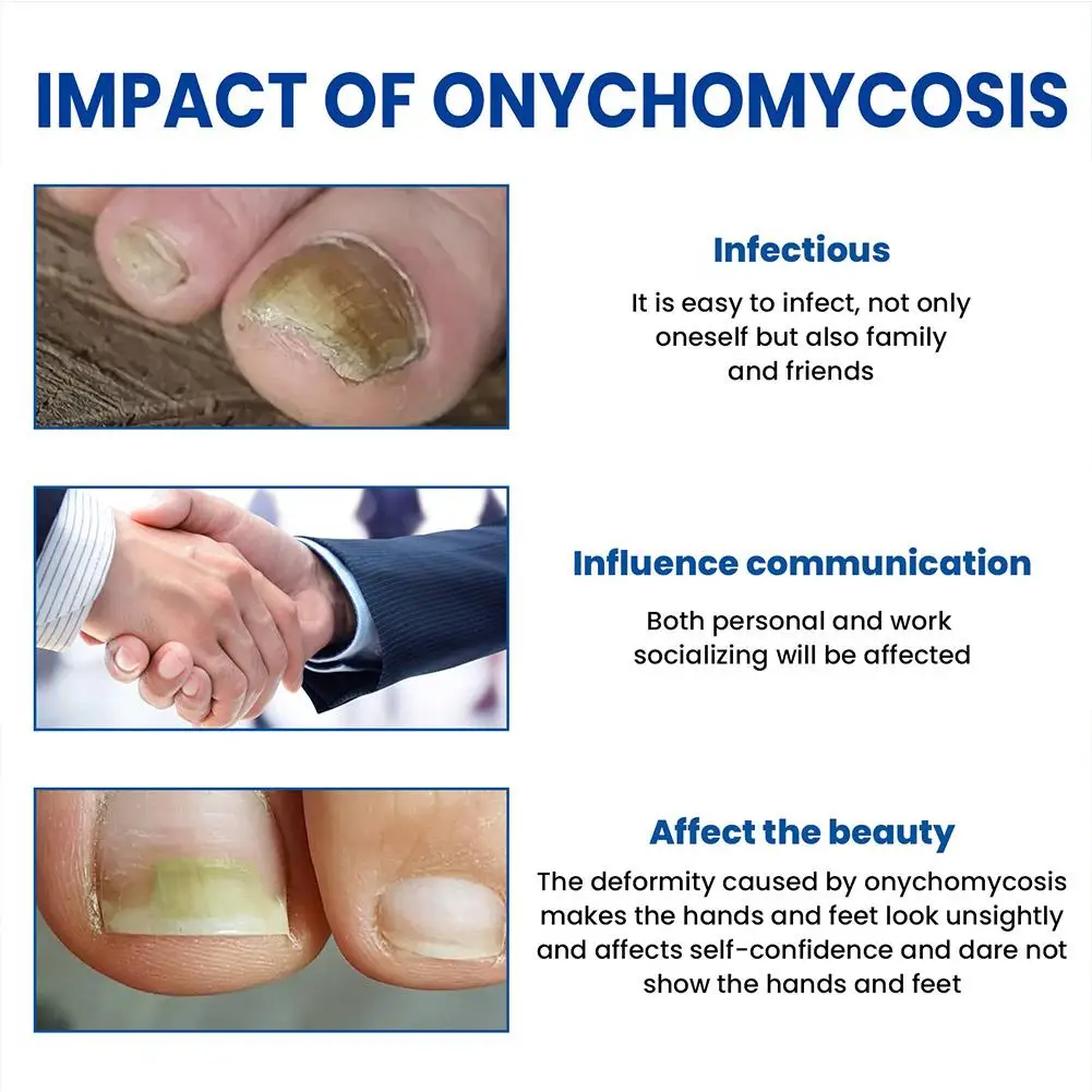 Naklejki na grzybicę paznokci u stóp Szara grzybica paznokci Zagęszczenie miękkiego paznokcia Zanokcica Infekcja Naklejka korygująca paznokcie u rąk Narzędzie do pielęgnacji stóp