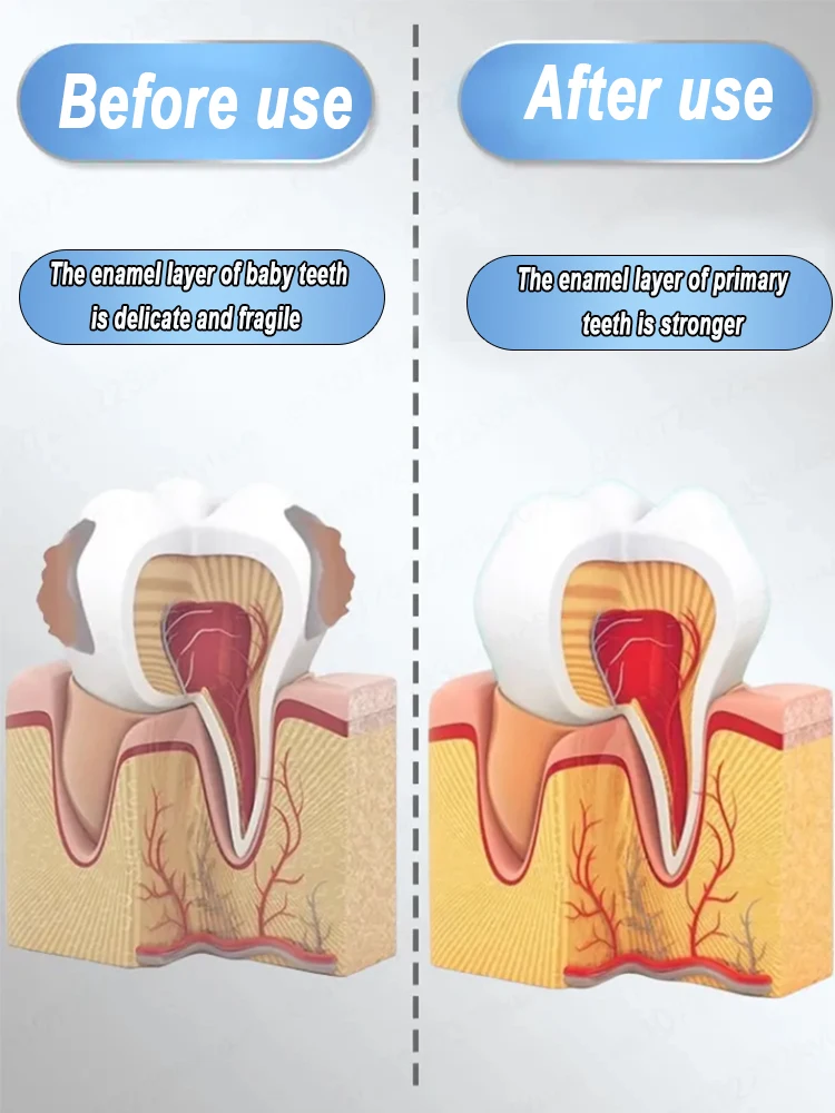 Utilice extractos de plantas naturales para reparar las caries, blanquear los dientes y eliminar las caries.