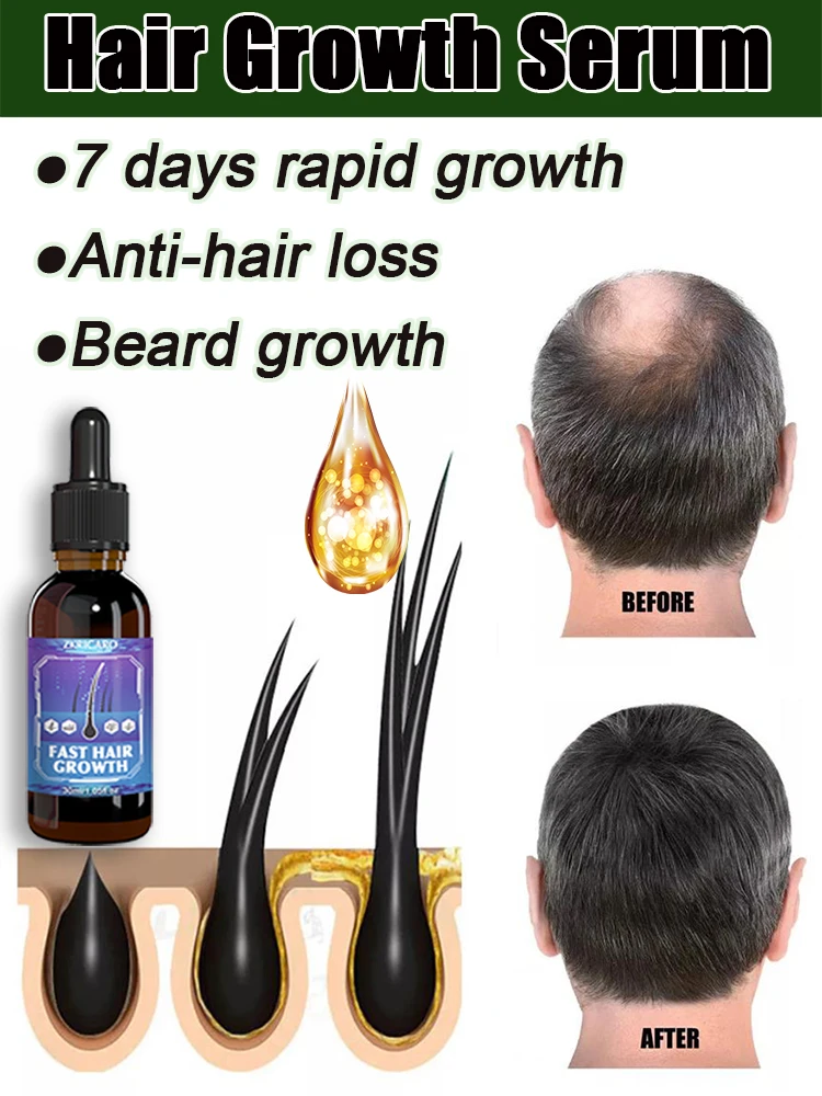 Хит продаж, 99% покупателей покупают снова, у них все больше волос, попрощайтесь с облысением, густыми волосами Хит продаж, 99% покупателей покупают снова, у них все больше волос, попрощайтесь с облысением, густыми волосами