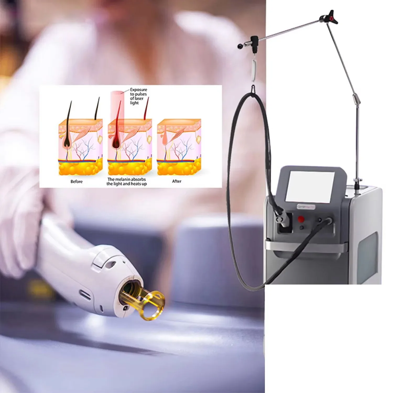 Alex pro Max Laser Hair Removal Machine 755/1064 Nd Yag Alexandrite Cooling Long Pulse Professional Beauty Salon Equipment