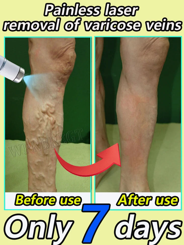 Rapid removal of varicose veins, phlebitis, venous dilatation, spider legs