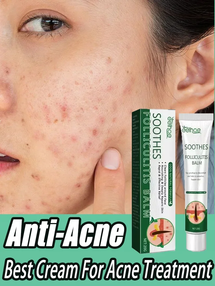 Anti-Acne Cream Effectively Removes Skin Nodules Pustules Cysts Papules Blackheads Men And Women Acne Skin Care Essence Cream