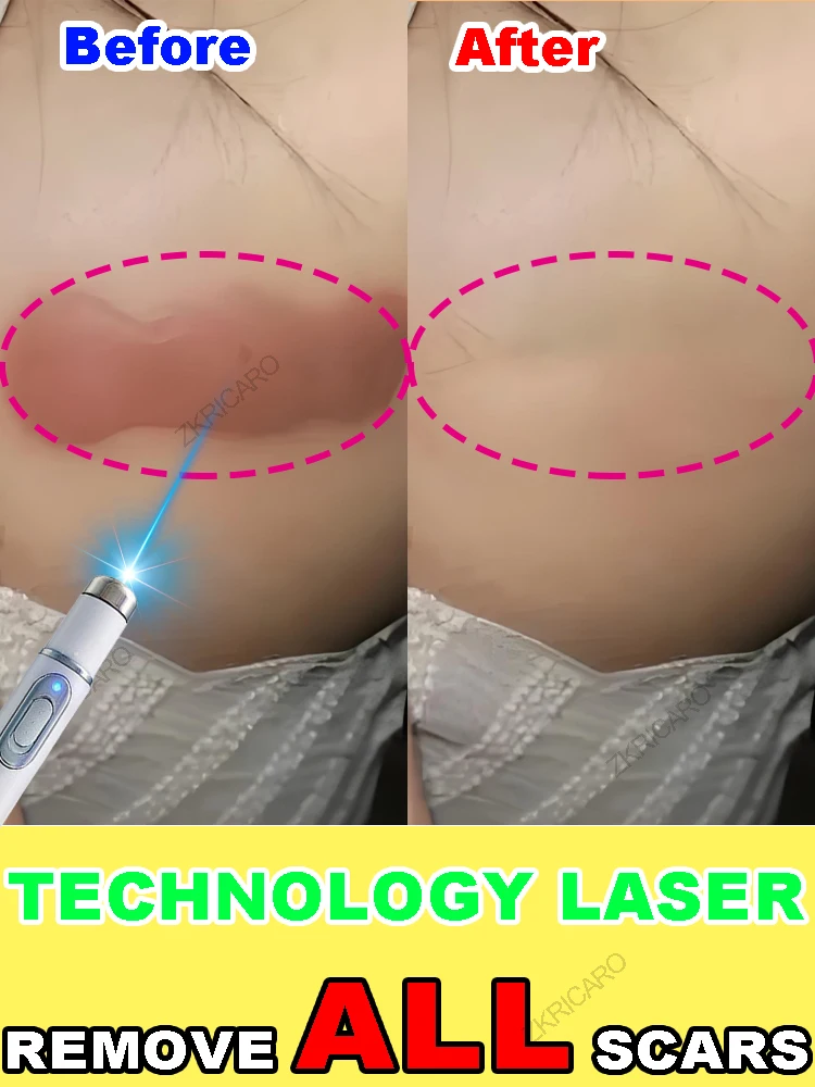 

The latest laser technology, scars disappear