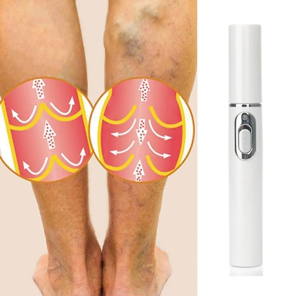 Blue Light Therapy Varicose Vein Pen Medical Varicose Scar Vein Pen Light Blue Acne Therapy Treatment