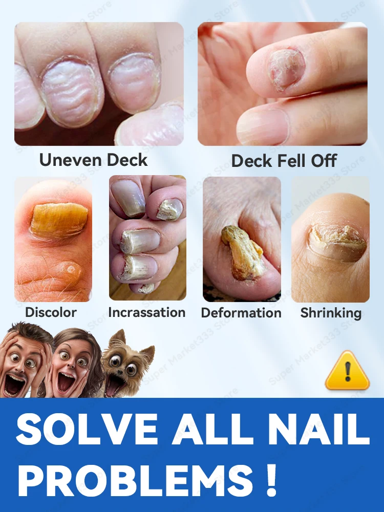 Feet Nail Problems Solved completely