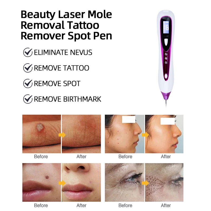 LESEN Professional Mole Removal Pens Remove Pigmented Nevus Improve Minor Skin Imperfections Convenient and Flexible Operation
