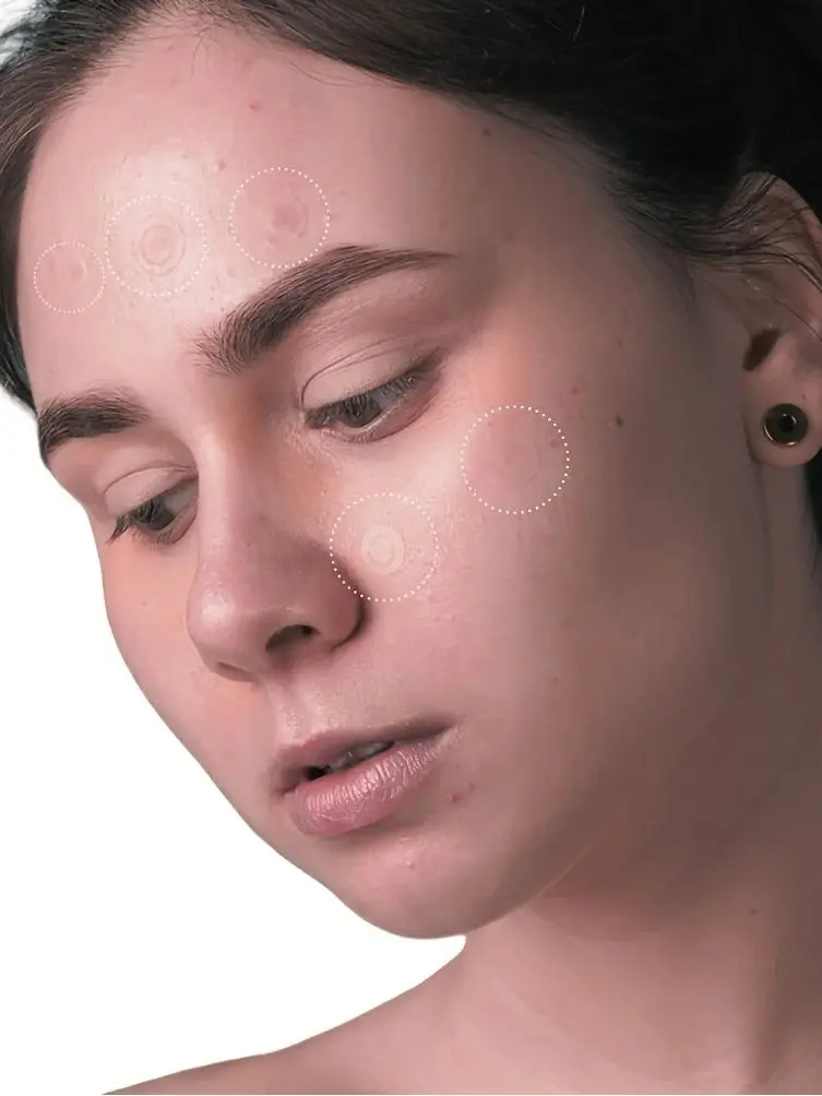 36 patchs hydrocolloïdes contre l'acné – Absorbant le Pus & Oil, réduit les rougeurs, ajustement invisible pour un usage toute la journée.