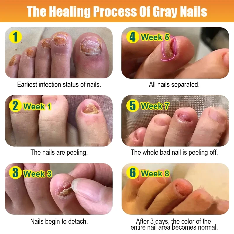 Pilz Nagel Behandlung Essenz Fuß Nagel Pilz Entfernung Reparatur Serum Anti Infektion Paronychie Onychomykose Fuß Nagel Pflege Creme