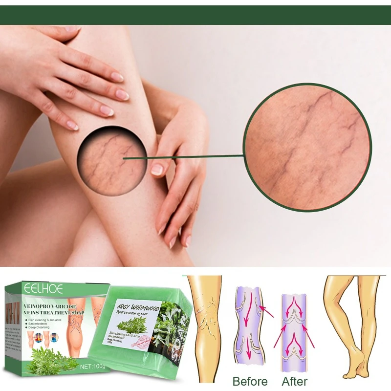 Savon de massage pour les varices Regina Charleroi, soin nettoyant, réparation des jambes, vascularite, phlébite, angiite, douleur des jambes, vers de terre, traitement