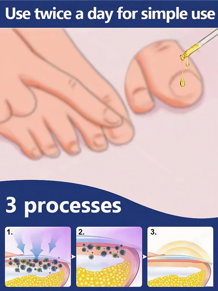 Schnell und harmlos – 100 % wirksam bei der Behandlung von Onychomykose. Schnell und harmlos