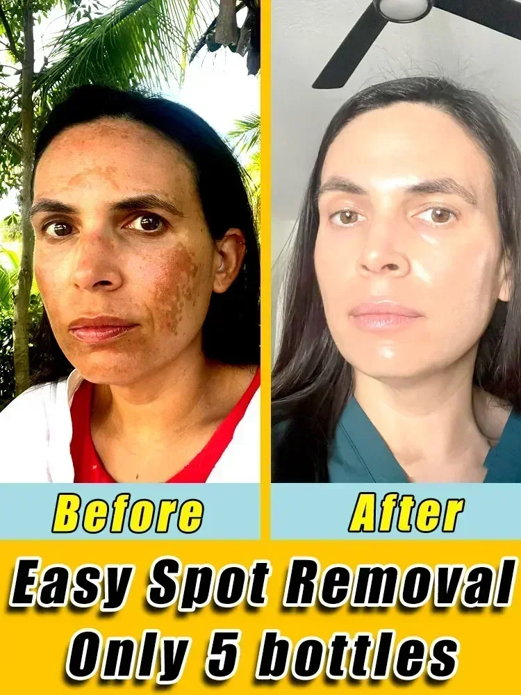 Freckles Removal Cream Remove Facial Spots Skin Dark Spot Remove Melasma Age Spots Sunspots Whitening And Freckle Removing Cream