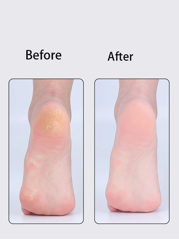 Removing dead skin and calluses, repairing heels, rubbing feet, nano grinding feet, and foot bumps