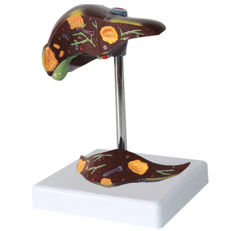 

Medical Teaching Equipment Anatomical Model Human Liver Damage Model Hepatic Portal Structure Hepatic Lobe