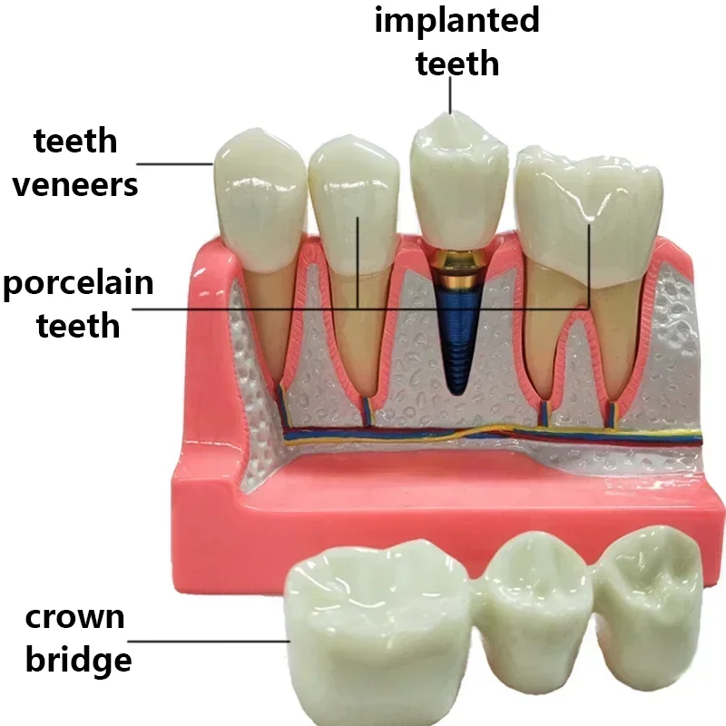 Dental Implant Teach Crown Bridge Removable Model Porcelain Teeth Model Dental Demonstration Model for Dentist Teaching