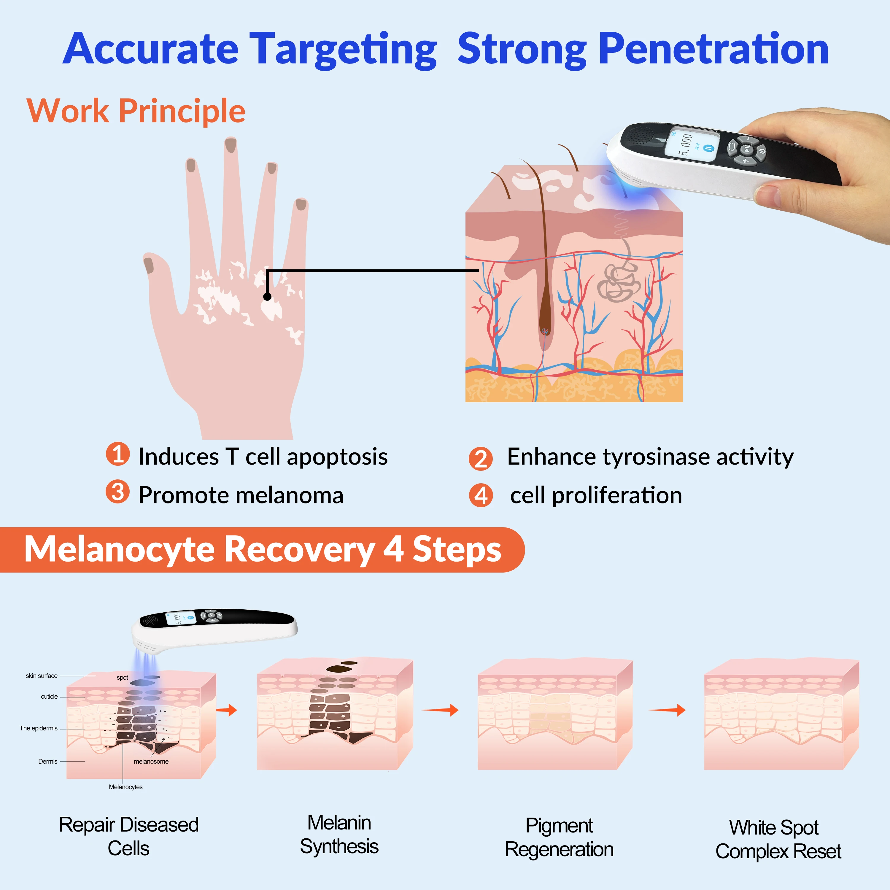 ZJZK 308nm UVB 광선 요법, 백반증 피부 재생, 건선, 습진 치료용 가정용 광선 요법, 좁은 UVB 광선 램프