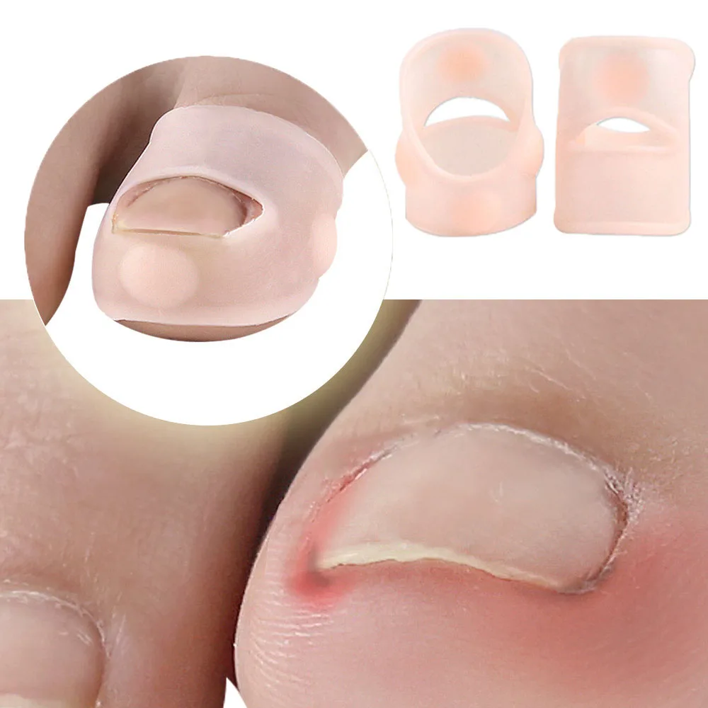 1Pair Silicone Ingrown Toenail Correction Tool Invisible Ingrown Toe Nail Treatment Elastic Straightening Clip Brace