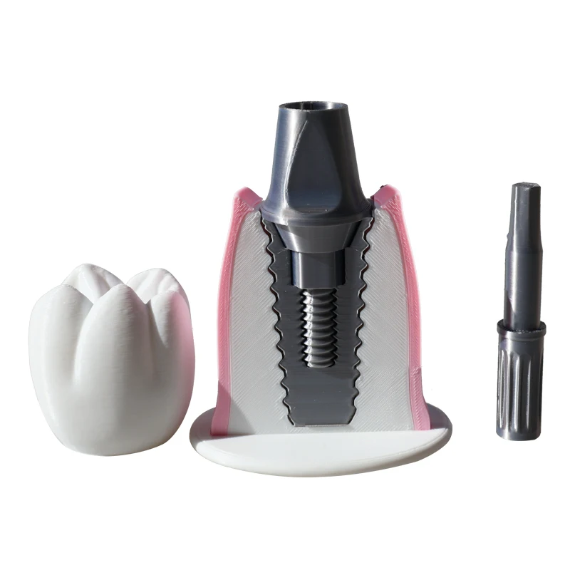 Removable implant model, oral teaching model, detachable dental denture model, doctor-patient communication model