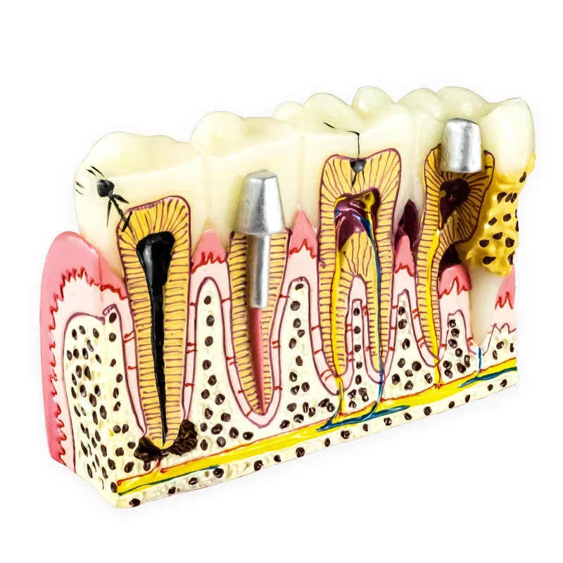 Tandheelkundige Implante Modelherstel Pathologisch Tandmodel Tandheelkundig Anatomisch Model Voor Tandheelkundig Onderwijs Training Tandarts Leren