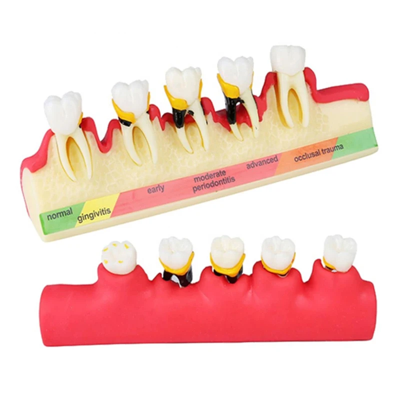 

Dental Disease Model M4010 Caries Demo Model Demonstrates Progress of Periodontal Disease Dental Study Teeth Model for Dentist