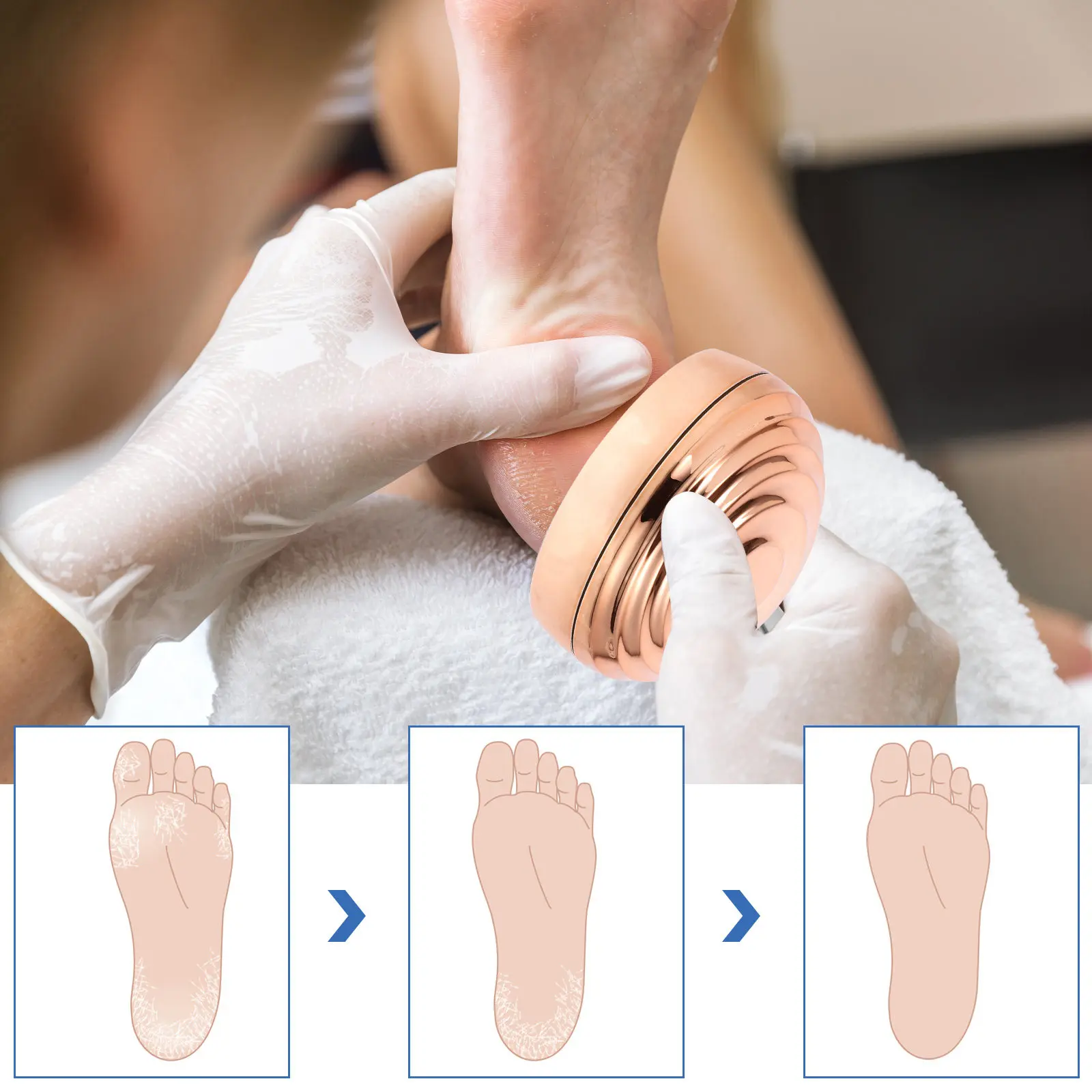 Foot File for Pedicure Calluses Remover Stainless Steel Exfoliator for Dry Cracked Feet Foot Massage Stimulates Acupuncture