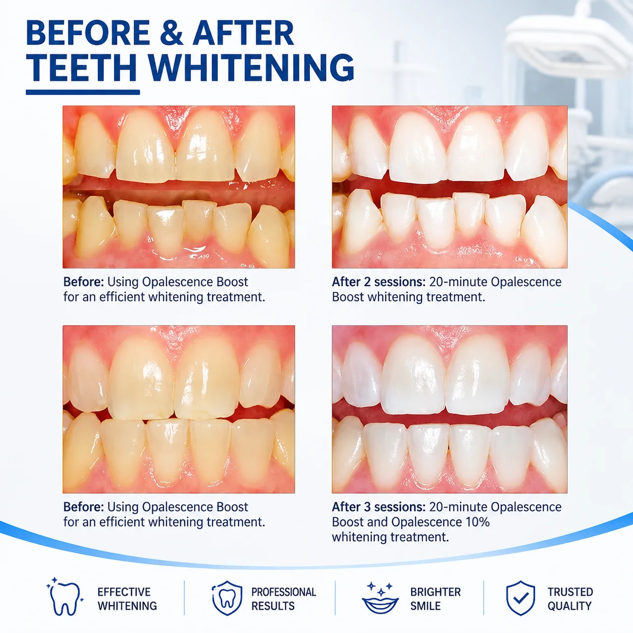 Gel sbiancante professionale a - Teeth Whitening In Office recensione e prezzo