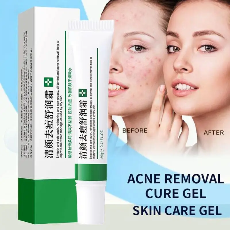 Acne Verwijderingscrème Sproet Crème Krimpen Poriën Whitening Hydraterende Olie Controle Acne Crème Huidverzorging Acne Behandeling Gezichtscrème