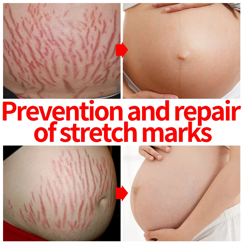 Natural Removal Pregnancy Essential Oils Prevent Stretch Marks From Growing Postpartum Repair Fade Abdominal Scars Firm Skin