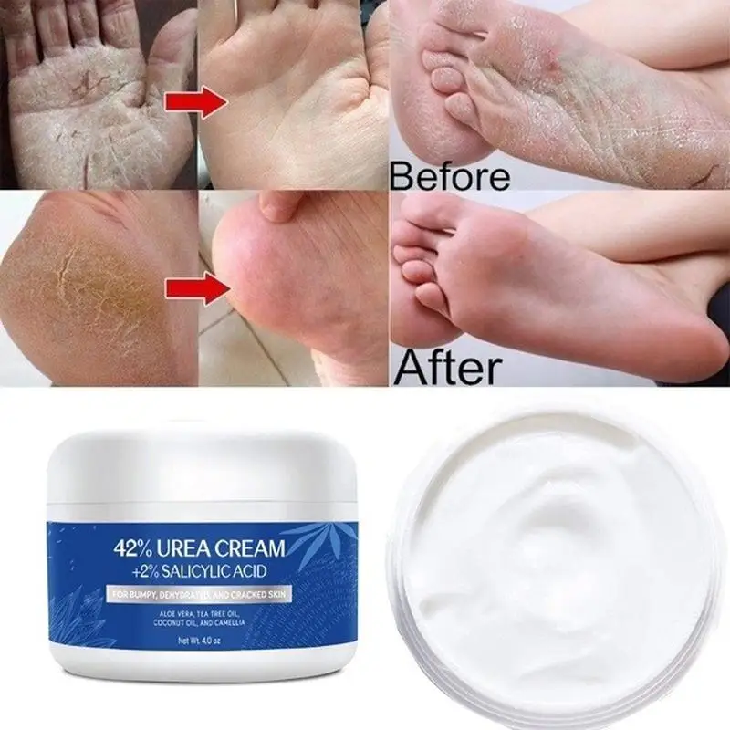 

Urea Cream 42% Plus Salicylic Acid 4 Oz, Upgraded Callus Remover Hand Cream Foot Cream for Dry Cracked Feet, Hands,