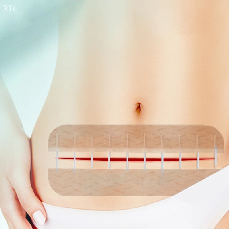 1 قطعة سستة التعادل الجرح إغلاق التصحيح المحمولة خياطة سريعة مرقئ التصحيح ضمادة مرنة في الهواء الطلق الإسعافات الأولية أداة العناية بالبشرة