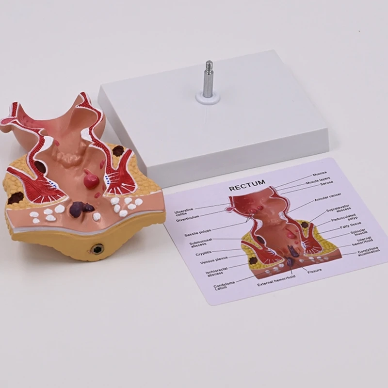 Human Pathologies of Rectum Model Teaching Aid Practical Human Rectum Model Dropship